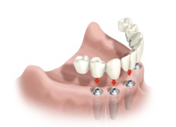Full Arch / Mouth Solutions