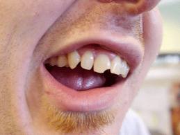 chipped-tooth