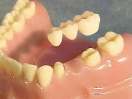 dental-bridge