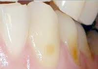 exposed-dentin