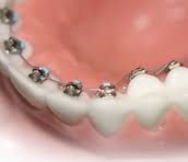 lingual-braces
