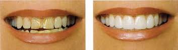 lumineers-before-after