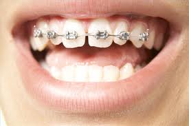 metal-braces