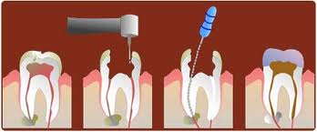root-canal-treatment