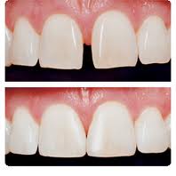 tooth-bonding