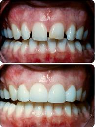 veneer-b-a-1