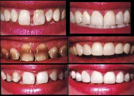 veneer-b-a-2