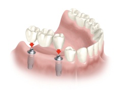 Multiple Dental Implant Options
