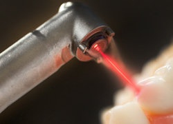 Laser Treatments