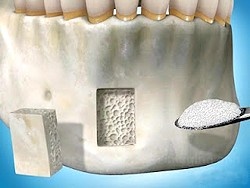 Bone Block treatment