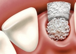 Bone Grafting