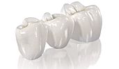 Dental bridge Dental bridge