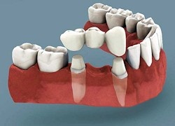 Dental Bridges