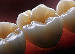 Dental Crowns