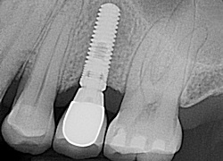Single Dental Implant Single Dental Implant