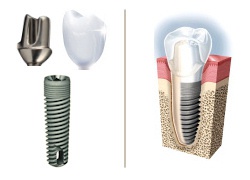 Market Leader Dental Implant with Crown