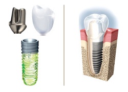 Quick Healing Dental Implant with Crown