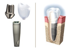 Regular Dental Implant with Crown (single tooth)