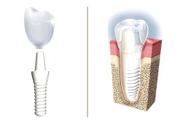 "Non Metal" Zirconia Dental Implant & Crown