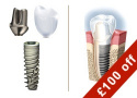 Instant Discount of &pound;100 on Advanced Dental Implants