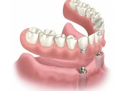 Removable Denture with two ’ball’ connections Removable Denture with two ’ball’ connections