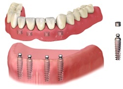 Removable Denture with four ’ball’ connections