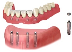 Removable Denture with four ’ball’ connections Removable Denture with four ’ball’ connections
