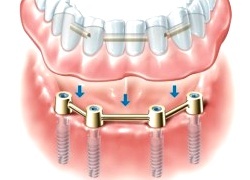 Removable denture with four ’bar’ connections