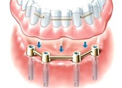 Removable denture with four ’bar’ connections Removable denture with four ’bar’ connections