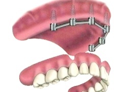 Removable denture with six ’bar’ connections