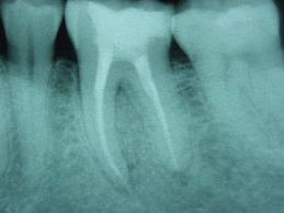 root-canal-xray